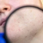 blackhead