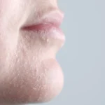 Dry Skin
