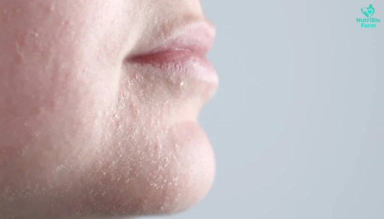 Dry Skin