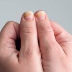 Ridges on Nails