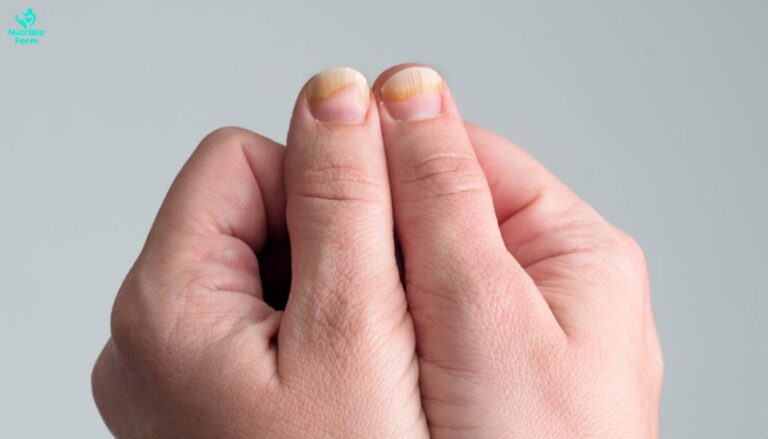 Ridges on Nails