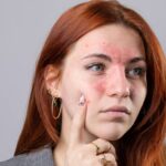 Rosacea