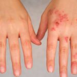 Eczema