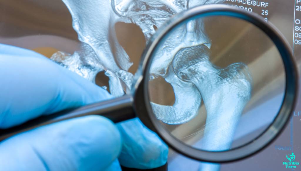What is Osteoarthritis?