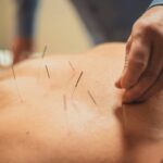 Acupuncture