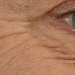 Wrinkles